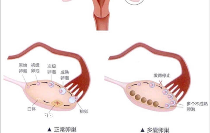 多囊卵巢会引起卵泡过多