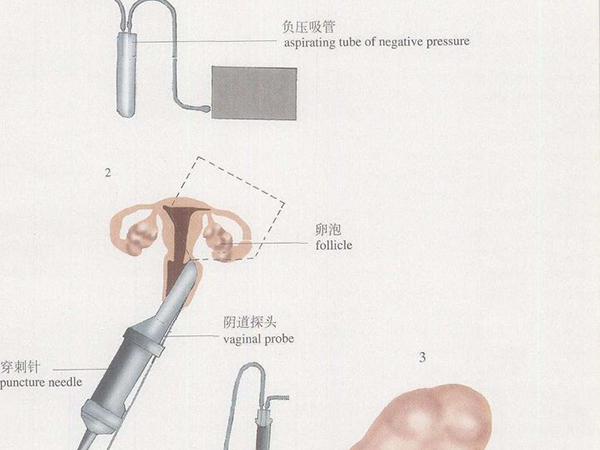 取卵手术示意图