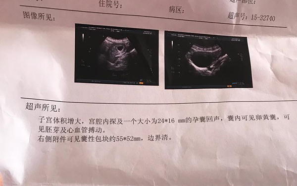 确诊怀孕的b超单上面有孕囊大小等